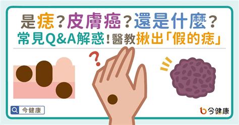 身體痣的好壞|是痣or皮膚癌？醫「1張圖秒對照」 長這2部位最危險